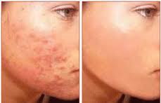 Web Cini Alerji Nedir Alerji Belirtileri Tedavisi Ve Testleri