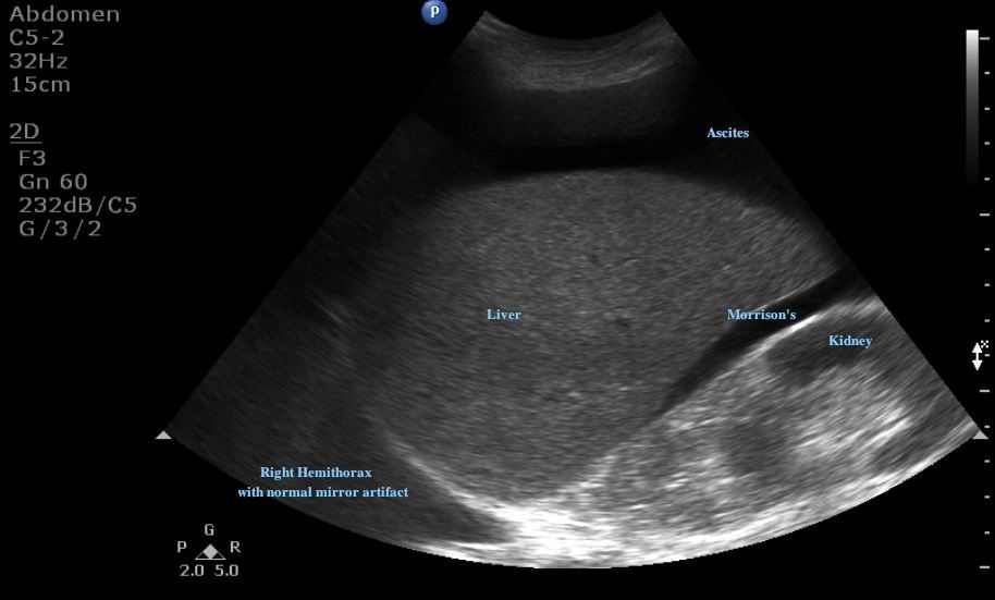 Ultrasound for Paracentesis Ultrasound Cases Info