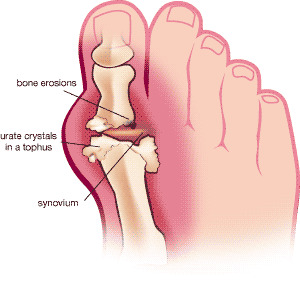 Ubat Gout