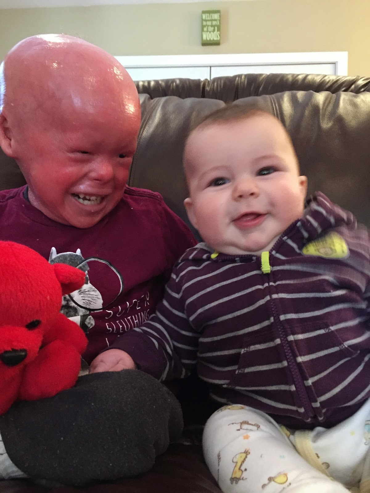 Evan, who has Harlequin Ichthyosis,with his brother 