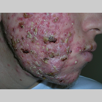 Steroid acne on face