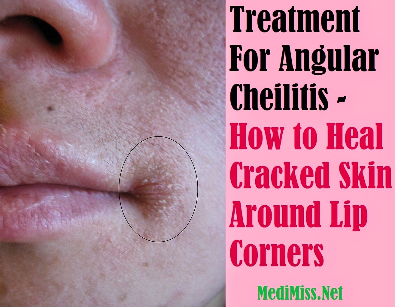 Natural Treatment For Painful Cracks In Corner Of Mouth Natural Treatment For Painful Cracks In Corner Of Mouth