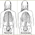 Hablemos de Escoliosis (Parte I: Introducción)