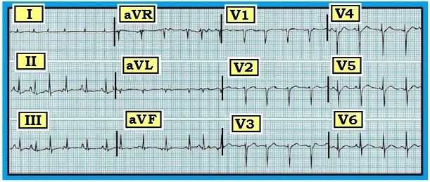 Ecg Interpretation Ecg Interpretation Review 65 Svt Rvh