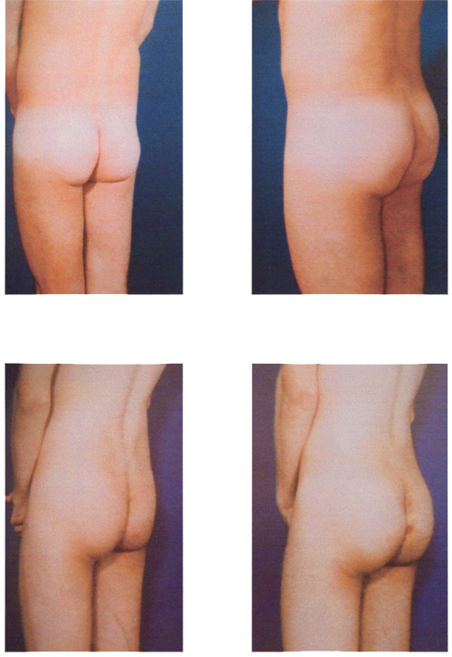 GLUTEOS AUMENTO gluteos aumento: