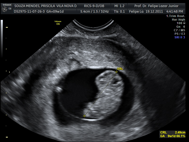 Exame de sexagem fetal