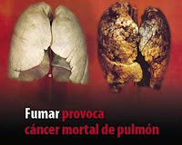 Demanda a Sanidad por el daño del tabaco Cancer+letal+del+pulm%25C3%25B3n+isquemia+que+ocurre+si+fumas