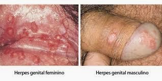 Horroroso atopichesky la dermatitis