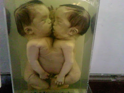 фото сиамских близнецов
