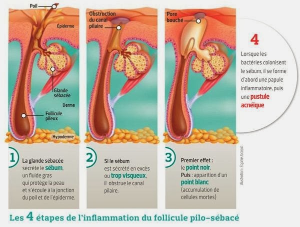 quand consulter médecin pour l'acné | médical santé quand consulter médecin pour l'acné | médical santé