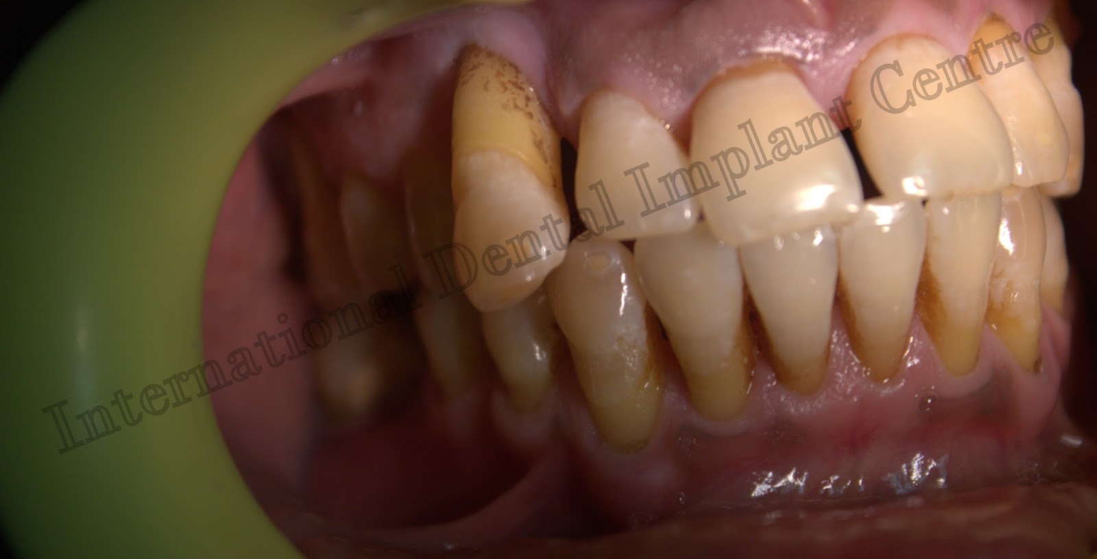 Basal Dental implants for Diabetic patients in INDIA International