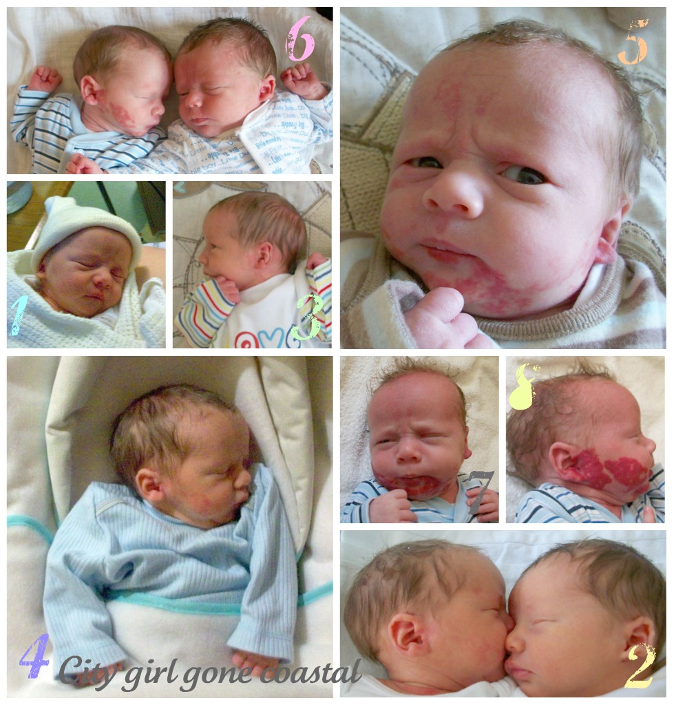 Definition Strawberry Mark Newborn at Nicole Esposito blog