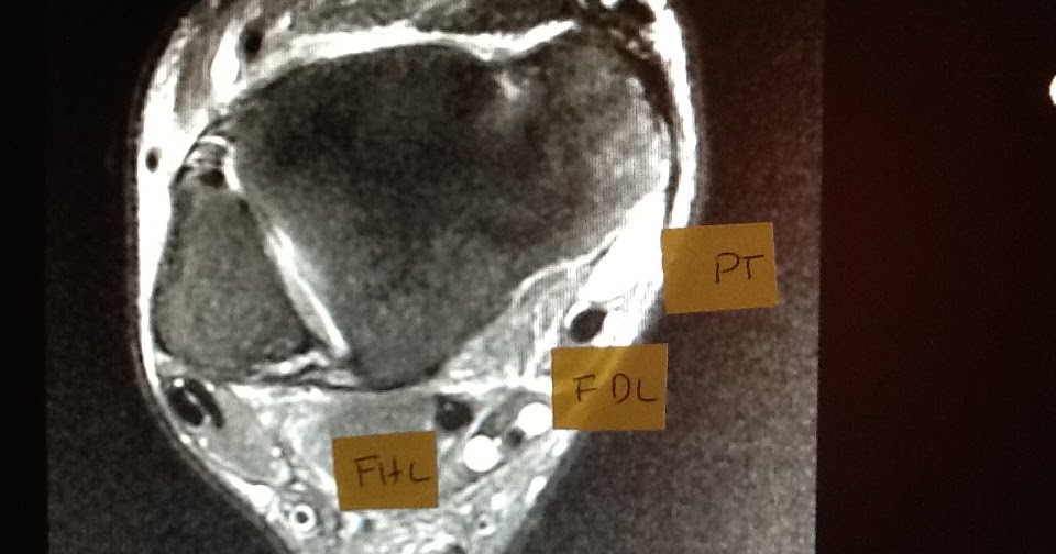 www.drblakeshealingsole.com (Foot and Ankle Problems): Posterior Tibial