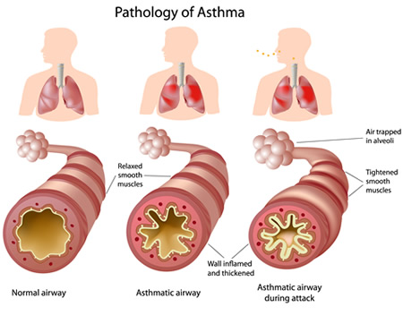 the causes symptoms and treatment of asthma The exact cause of asthma is not known these responses cause the symptoms of an asthma attack. the causes symptoms and treatment of asthma The exact cause of asthma is not known these responses cause the symptoms of an asthma attack.