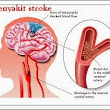 Pengobatan Tradisional Stroke Trombotik Teruji