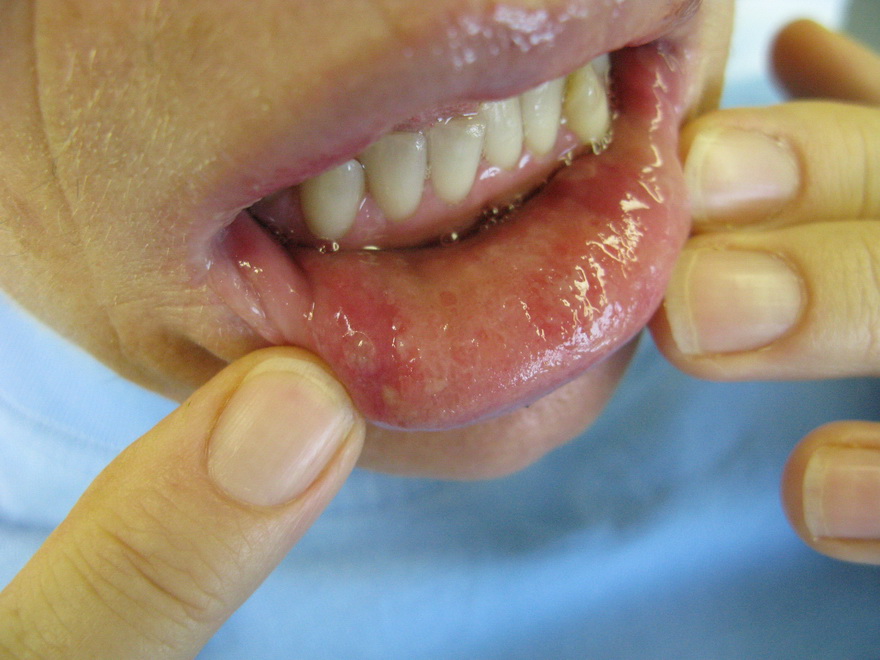 Dermatology For Dentists and Dental Students Lips