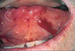 Amyloidosis | ppt Picture2 Amyloidosis | Definition , Etiology , Clinical features