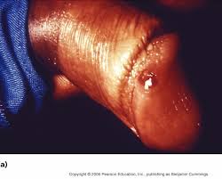 Obat Sipilis Yan Mujarab Obat Sipilis Yan Mujarab