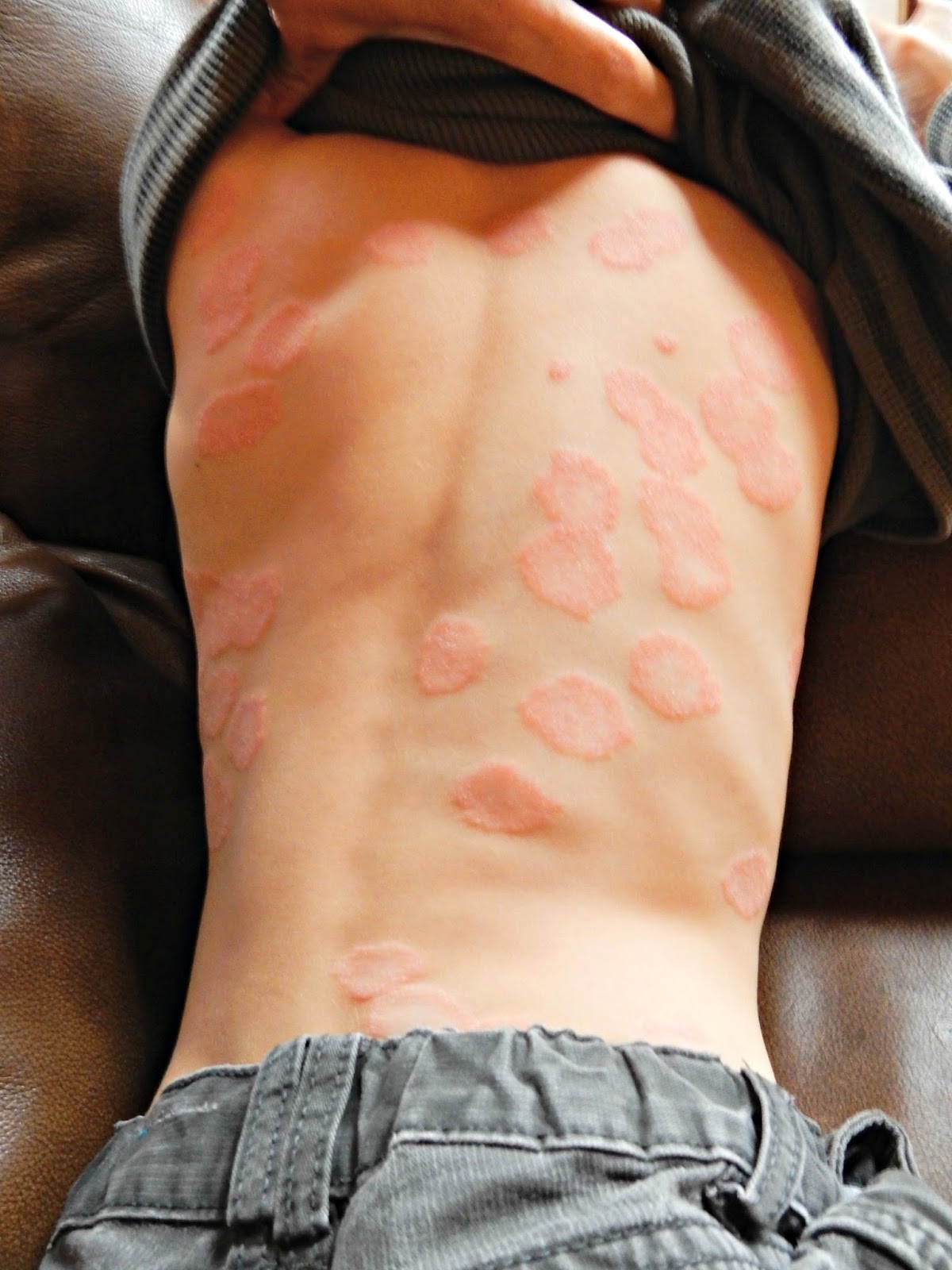 How I Saw My Psoriasis Through My Mothers Eyes forecast How I Saw My Psoriasis Through My Mothers Eyes recommendations