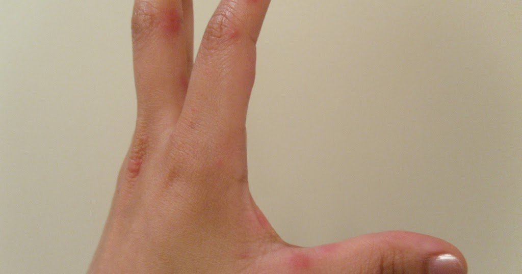 Que pastillas aplicar al hongo de las uñas