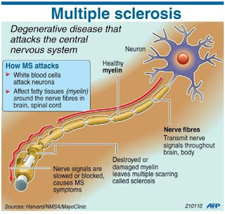 Multiple Sclerosis: Symptoms and Causes