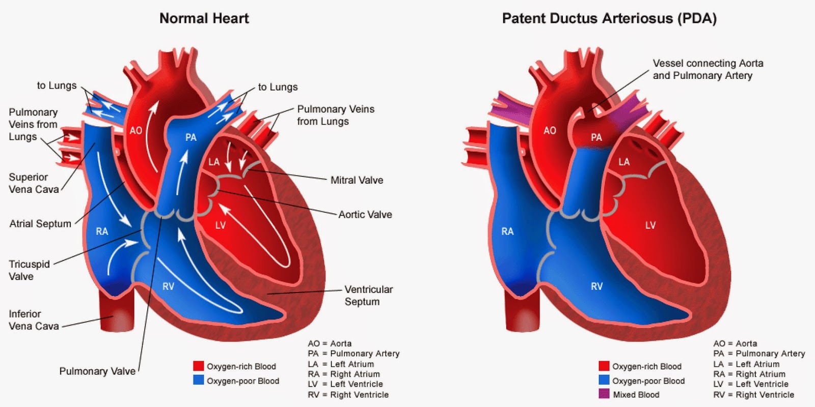 Natalie Rose Daily Update of our Micro Preemie PDA Ligation Surgery