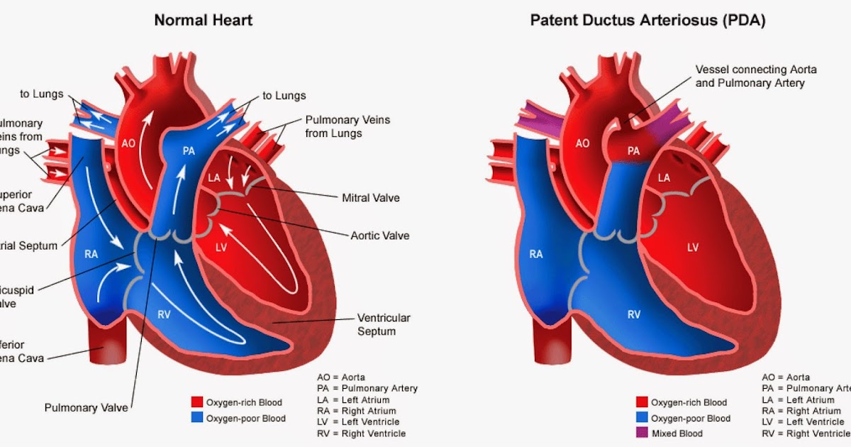 Natalie Rose Daily Update of our Micro Preemie PDA Ligation Surgery