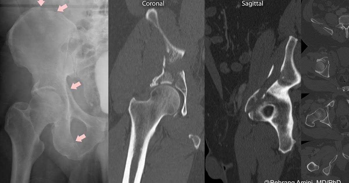 Roentgen Ray Reader Anterior Column Acetabular Fracture