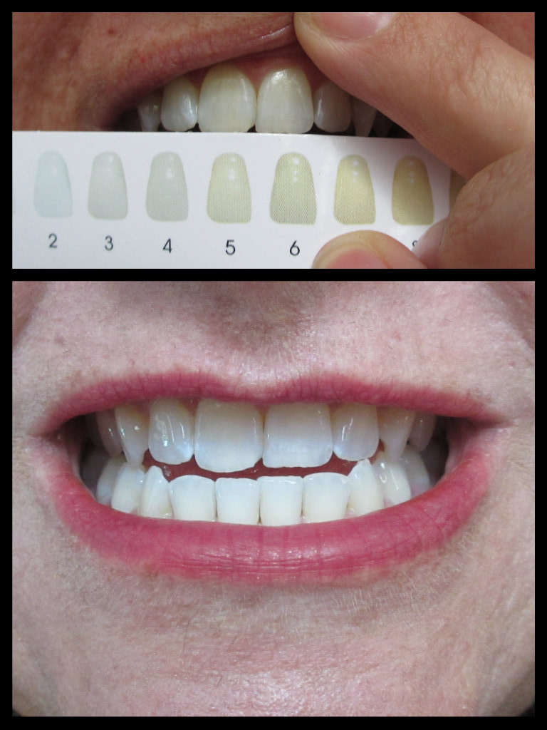 Cha Cha Cakes Nails At Home Teeth Whitening My Smile Bright Experience