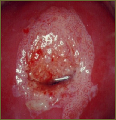 LESIONES EN EL CUELLO UTERINO lesiones en el cuello uterino: