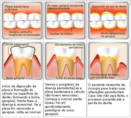 One Clinic: Você sabe o que é a doença periodontal?