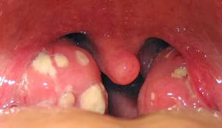 [Image: viem-amidan-co-the-gay-ap-xe-thanh-sau-hong.jpg]