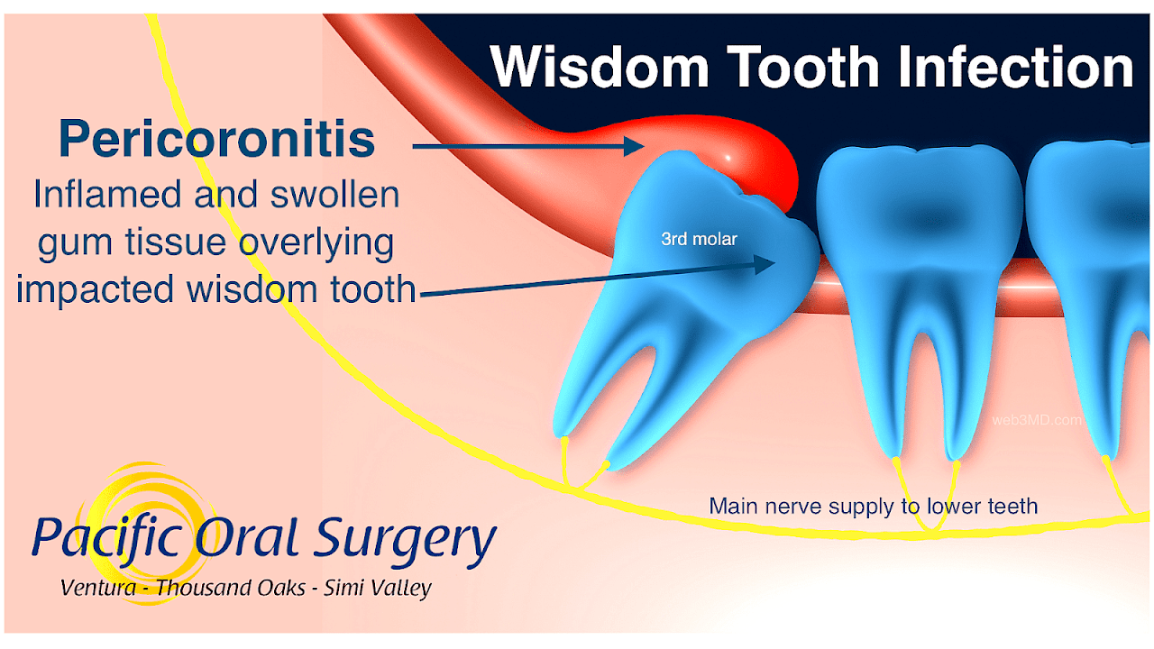 Wisdom Tooth Infection Treatment Home Treat Choices