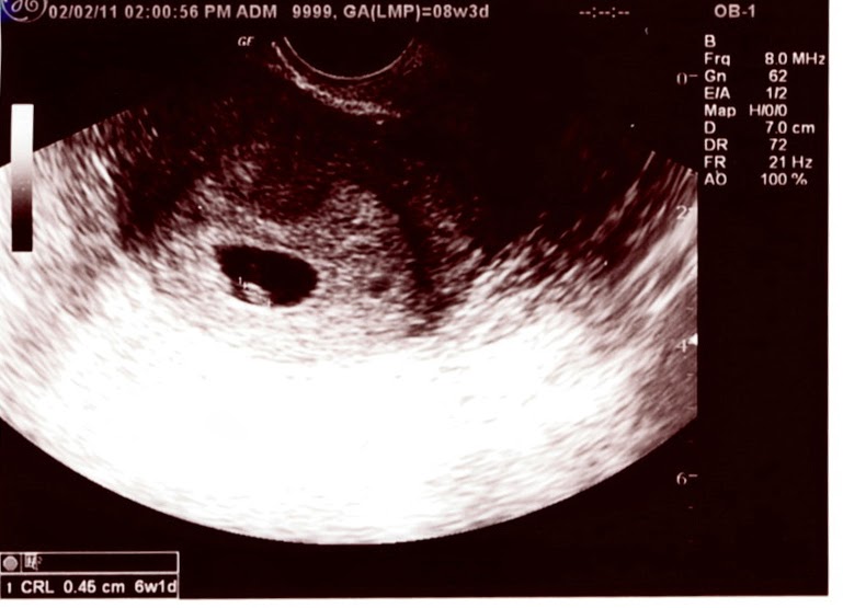 Inside Looking Out 3 DPO Or 3 days post ovulation & IUI!