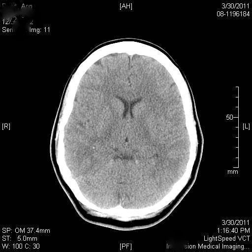 Do Root Canals Cause Breast Cancer?