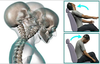 los síntomas de un latigazo cervical severo
