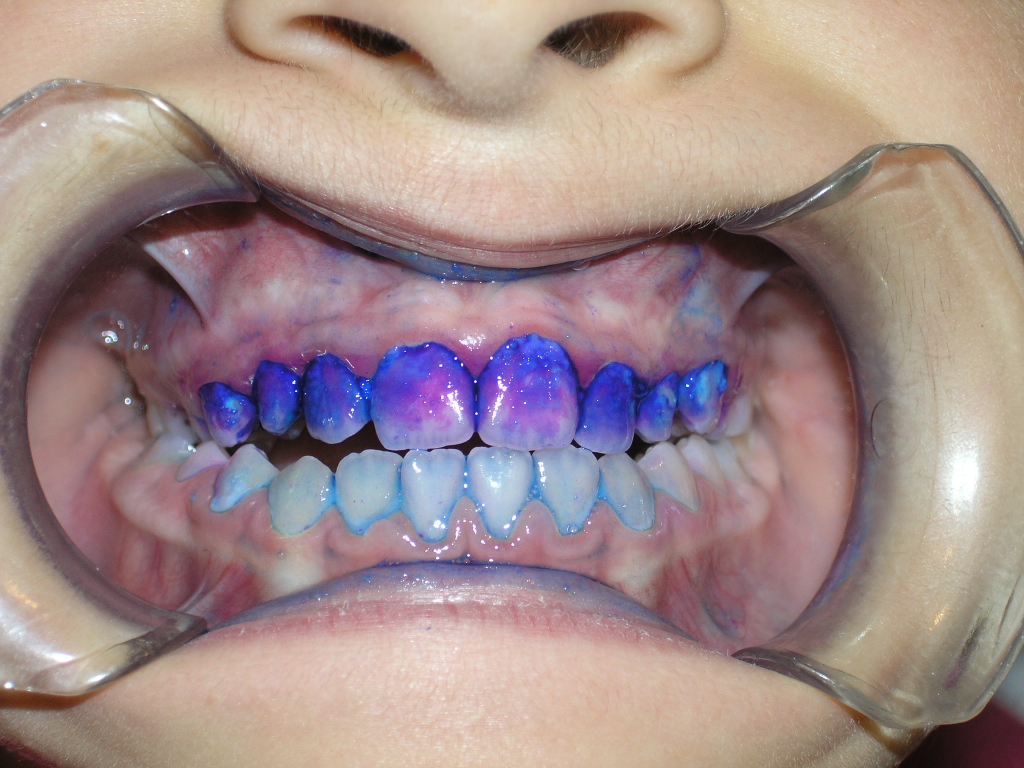 Ortodontist Dr Fircalanmayan Disler Uzerindeki Tabaka Boyanincaaaaaa