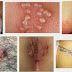 Obat Tradisional Kutil Kelamin thumbnail