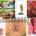 Berak Berdarah Segar dan Keluar Benjolan, Obatnya Apa thumbnail