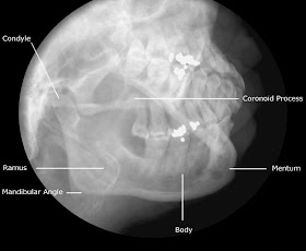 Adult+Mandible+-+Oblique.jpg