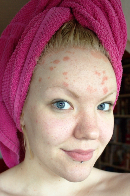 Zoffe's makeup Psoriasis dealing with having it on the face.