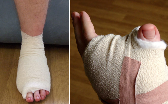7. - Homem teve o dedão do pé reimplantado na mão após acidente.