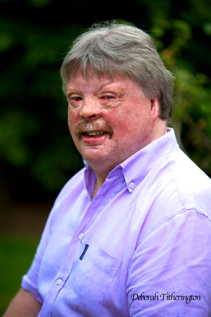 Simon Weston Burns