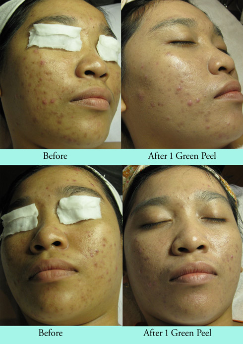 manfaat peeling pada wajah