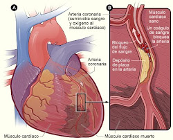 ARTERIOSCLOROSIS