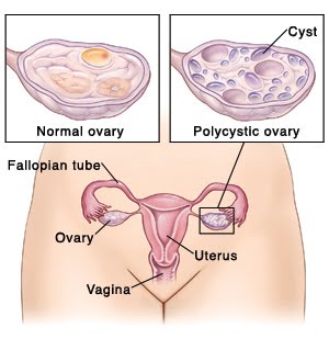 Reflexology Chart Ovarian Cyst