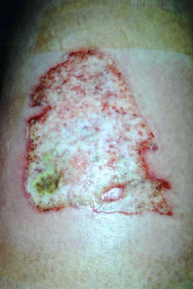 NoozYes : Schoolgirl left with Severe Burns after Nail Glue Spilled on Leg during DIY manicure