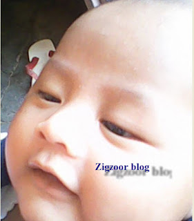 Cara Menghilangkan Noda Hitam Pada Kulit Bayi Bayi