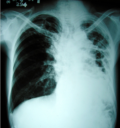 Ineffective Airway Clearance related to Pulmonary Tuberculosis | Nanda 