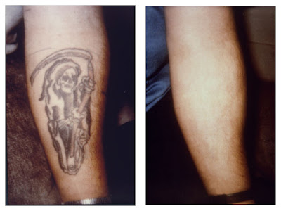 Removing Tattoos Removing Tattoos